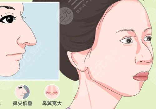 駝峰鼻矯正手術(shù)多少錢？