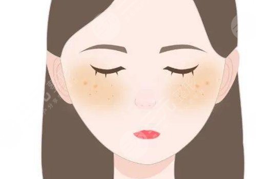 激光祛斑后反黑怎樣能快速消除?