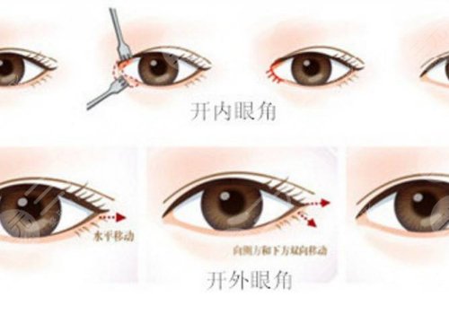 開(kāi)眼角加割雙眼皮一共多少錢(qián)?