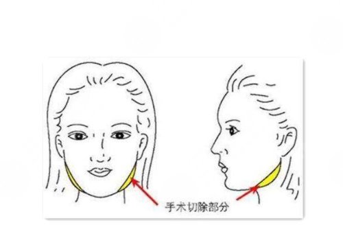 磨骨手術(shù)和削骨哪個(gè)更好?