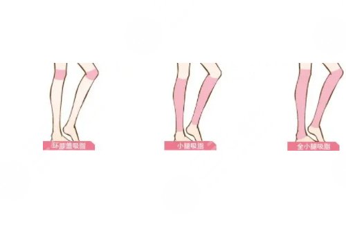 小腿吸脂恢復(fù)期要多久？有效果嗎？