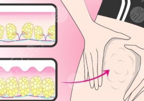 小腿吸脂恢復(fù)期要多久？有效果嗎？