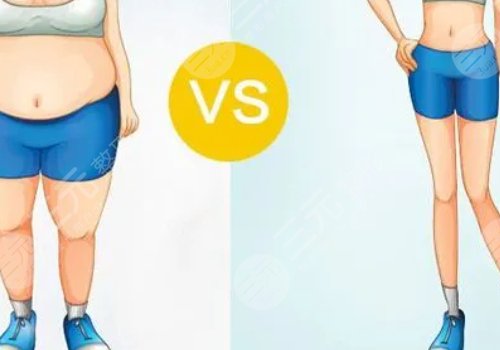 小腿吸脂恢復(fù)期要多久？有效果嗎？