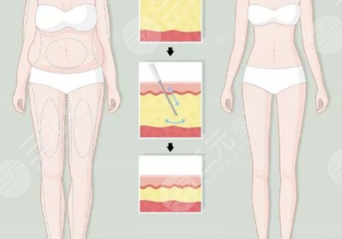 小腿吸脂恢復(fù)期要多久？有效果嗎？