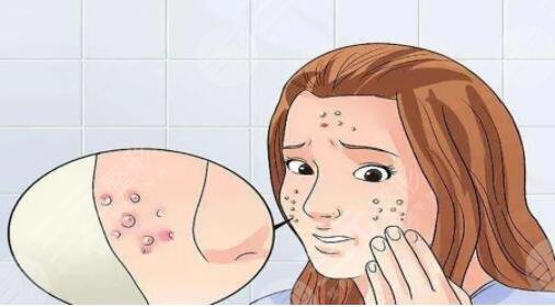 怎樣才能去除青春痘方法簡(jiǎn)單有效？網(wǎng)友和網(wǎng)紅測(cè)評(píng)的8種小技巧，快來(lái)get