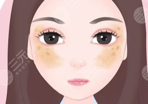 激光祛斑會(huì)不會(huì)反彈？需要做幾次？