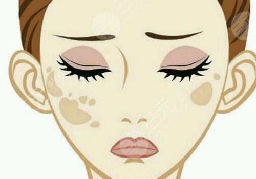 激光祛斑會(huì)不會(huì)反彈？需要做幾次？