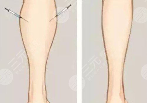 小腿吸脂后多久可以正常走路？