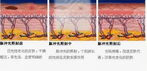 光子嫩膚緩解毛孔粗大效果
