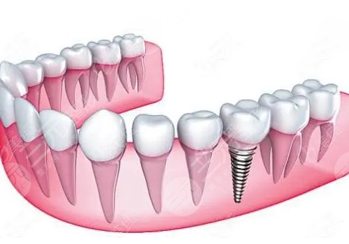 正常種一顆牙多少錢？