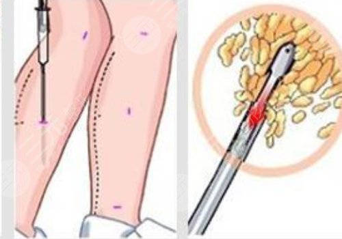 腿部吸脂手術(shù)有什么危害？