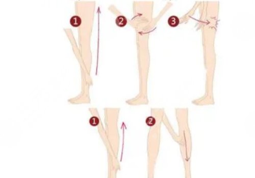 腿部吸脂手術(shù)有什么危害？