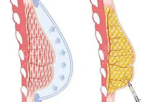 豐胸手術(shù)對(duì)身體有什么影響？