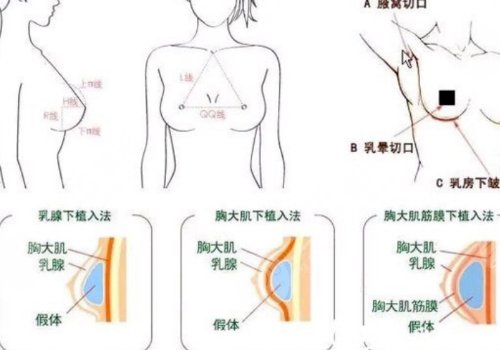 豐胸手術(shù)對(duì)身體有什么影響？