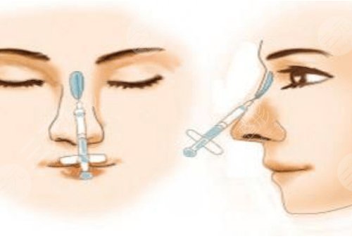 寶尼達(dá)玻尿酸適合注射在什么部位？