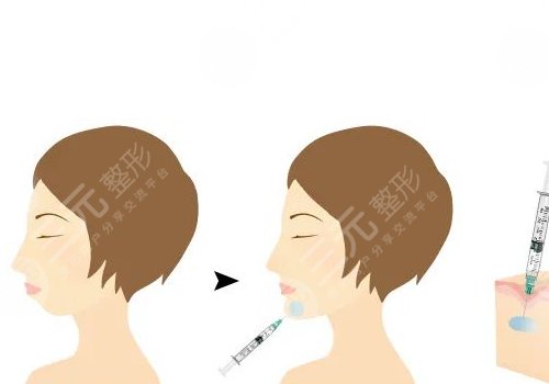 寶尼達(dá)玻尿酸適合注射在什么部位？