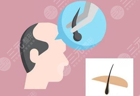 毛發(fā)種植的費(fèi)用是多少2023？價(jià)格影響根源所在，30秒速覽~