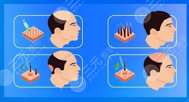 影響植發(fā)價(jià)格選擇因素