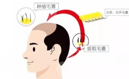 植發(fā)的具體操作