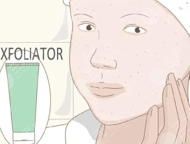 醫(yī)美去角質(zhì)的方法——如何選擇適合自己的醫(yī)美方式