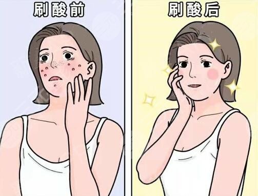 果酸換膚好不好?果酸換膚的優(yōu)點