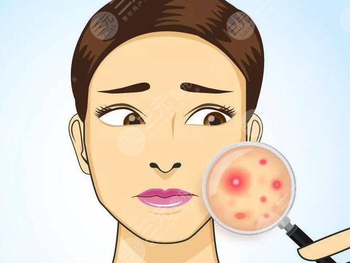 緩解青春痘時需要注意以下幾點(diǎn)：