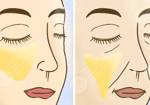 7d聚拉提美容的功效和副作用有哪些？