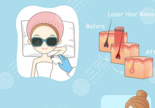 激光脫毛和冰點脫毛有什么區(qū)別？