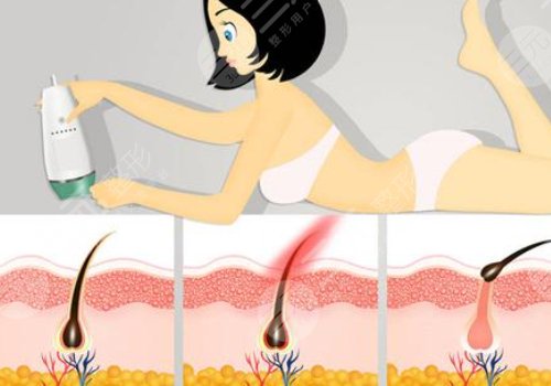 激光脫毛和冰點脫毛有什么區(qū)別？