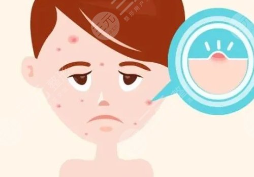 臉上痘坑怎么去除？
