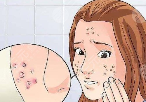 臉上痘坑怎么去除？