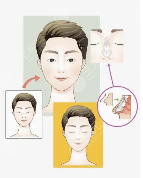 李愛林做鼻子怎么樣？醫(yī)生資料詳情、手術(shù)風(fēng)格夸張嗎？整友術(shù)后反饋來(lái)襲~