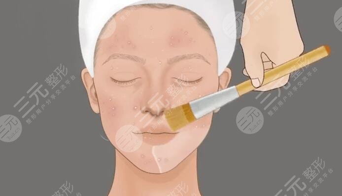 果酸換膚的副作用和危害多久會(huì)顯現(xiàn)出來？一文教你怎么避免風(fēng)險(xiǎn)和副作用！