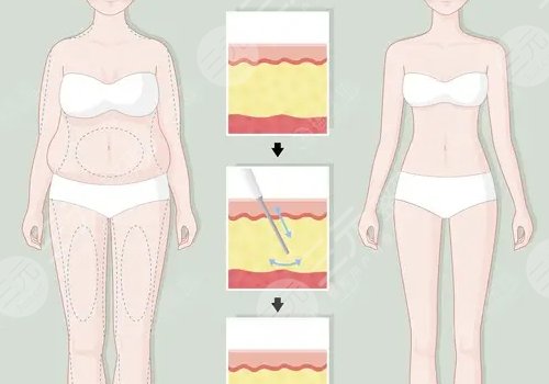 如何減去腹部贅肉？
