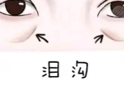 淚溝與眼袋的區(qū)別圖