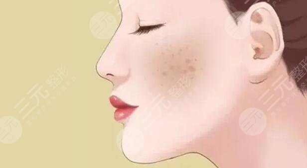 去除黃褐斑價格是多少？怎么預防和減少黃褐斑的出現(xiàn)？