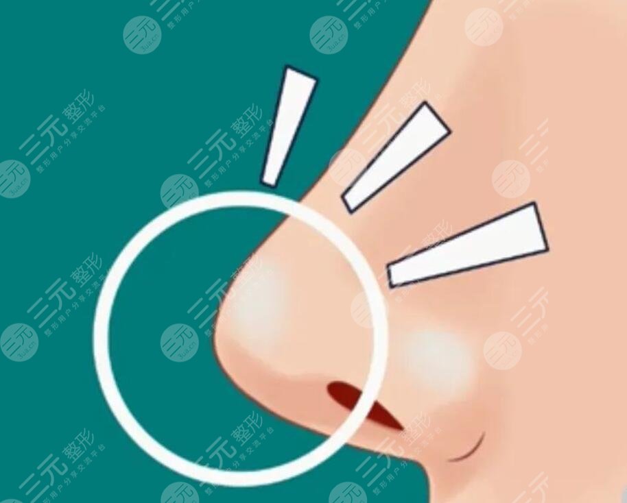 玻尿酸隆鼻有副作用嗎？該怎么避免玻尿酸隆鼻的副作用呢？