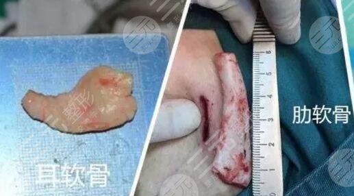 自體軟骨隆鼻的注意事項