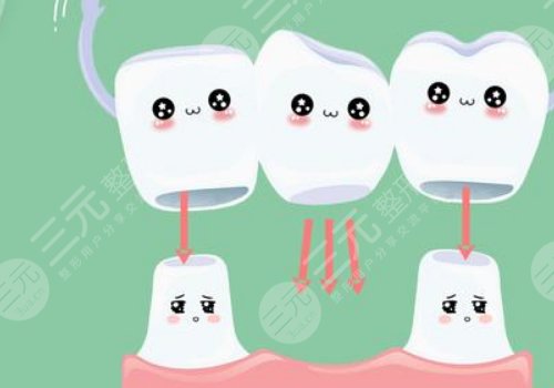 鈷鉻烤瓷牙套怎么樣？