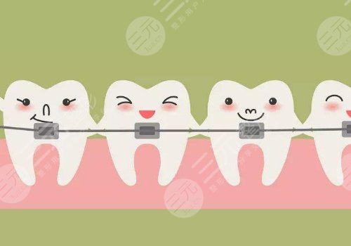 牙套價(jià)格一般是多少錢一個(gè)