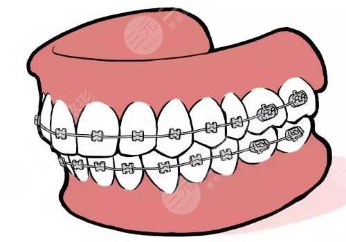 牙套價(jià)格一般是多少錢一個(gè)