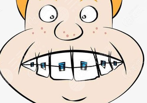 牙套價(jià)格一般是多少錢一個(gè)