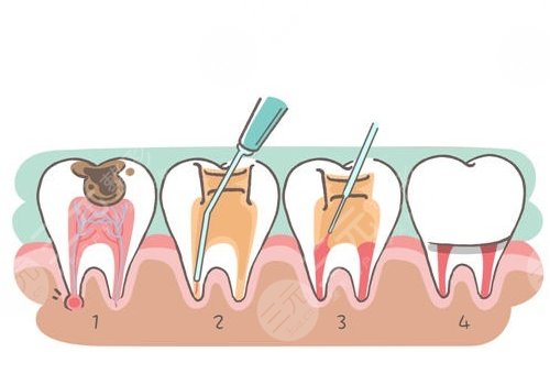 根管緩解一顆全部費(fèi)用