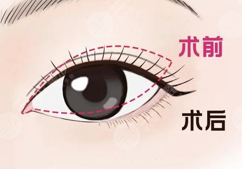 開眼角疼不疼呢？效果如何？