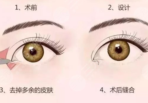 開眼角疼不疼呢？效果如何？