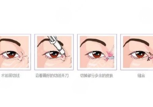 開眼角疼不疼呢？效果如何？