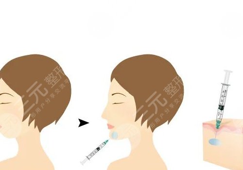 自體脂肪隆下巴多少錢？