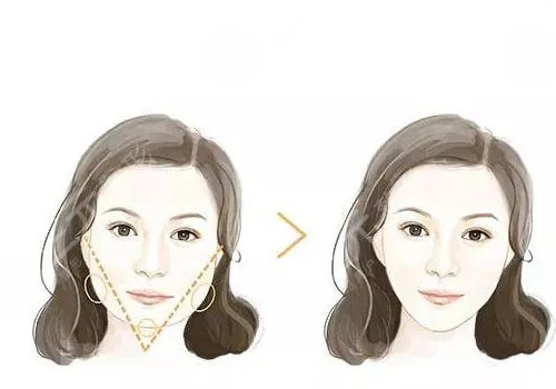 自體脂肪隆下巴多少錢？