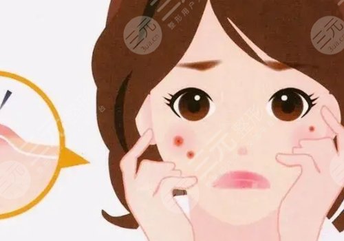 如何去除臉上的青春痘？