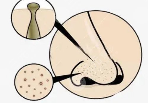 男性毛孔粗大油膩怎么改良？